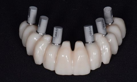 all on 6 dental implants in Turkey