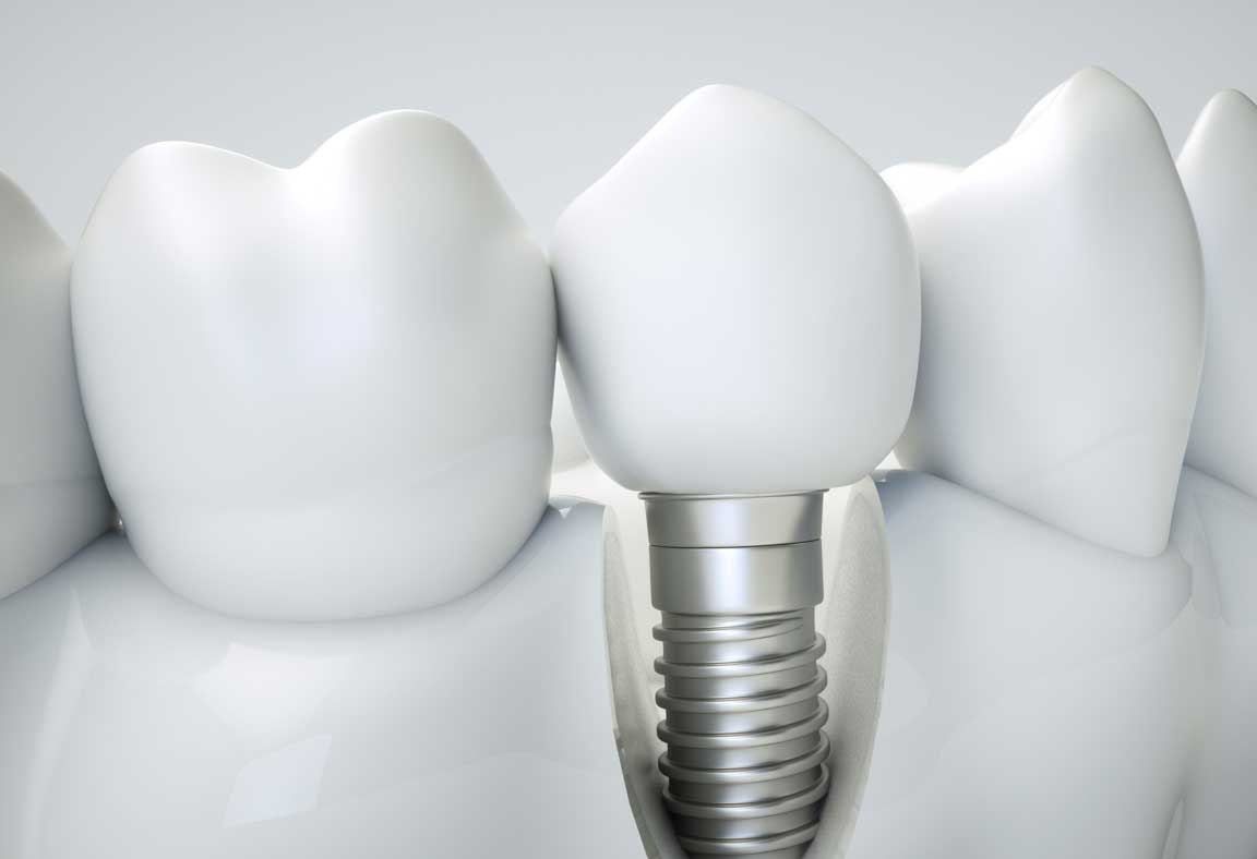 Comprehensive Analysis of Straumann Dental Implants in Turkey 2026