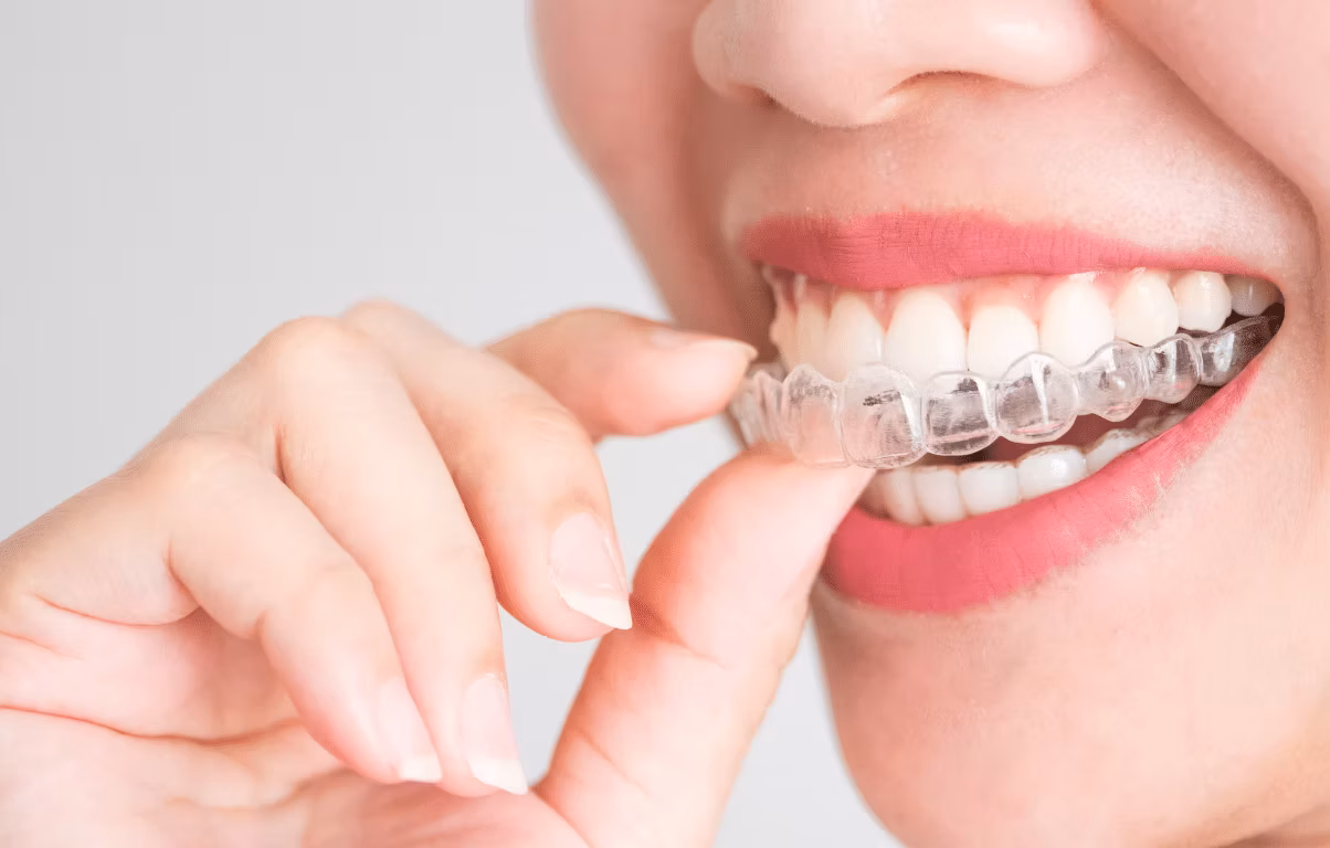 Şeffaf Plak Fiyatları 2026 (Invisalign): Tek ve Çift Çene Tedavi Ücretleri